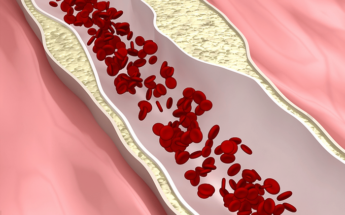 Statiinit: Mitä ne ovat ja miten ne vaikuttavat kolesteroliin?